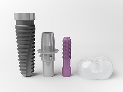 Dental Implants